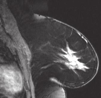 E and F, Breast MRI was performed to determine extent of disease.