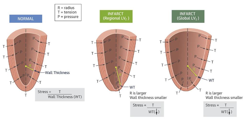 Left Ventricular Wall Stress, Geometry, and Remodeling in