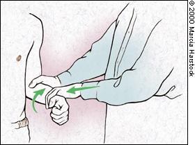 6-Tennis elbow test Passive wrist flexion/forearm pronation with elbow extended(+ve sign is pain at the origin of the common flexors of wrist, -ve sign is no pain)