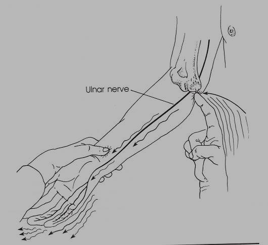 7-Tinel s test at medial epicondyle Compression at medial epicondyle(+ve sign is tingling at the ulnar nerve distributions) 8- Mobilization: is manual therapy designed to restore joint movement.
