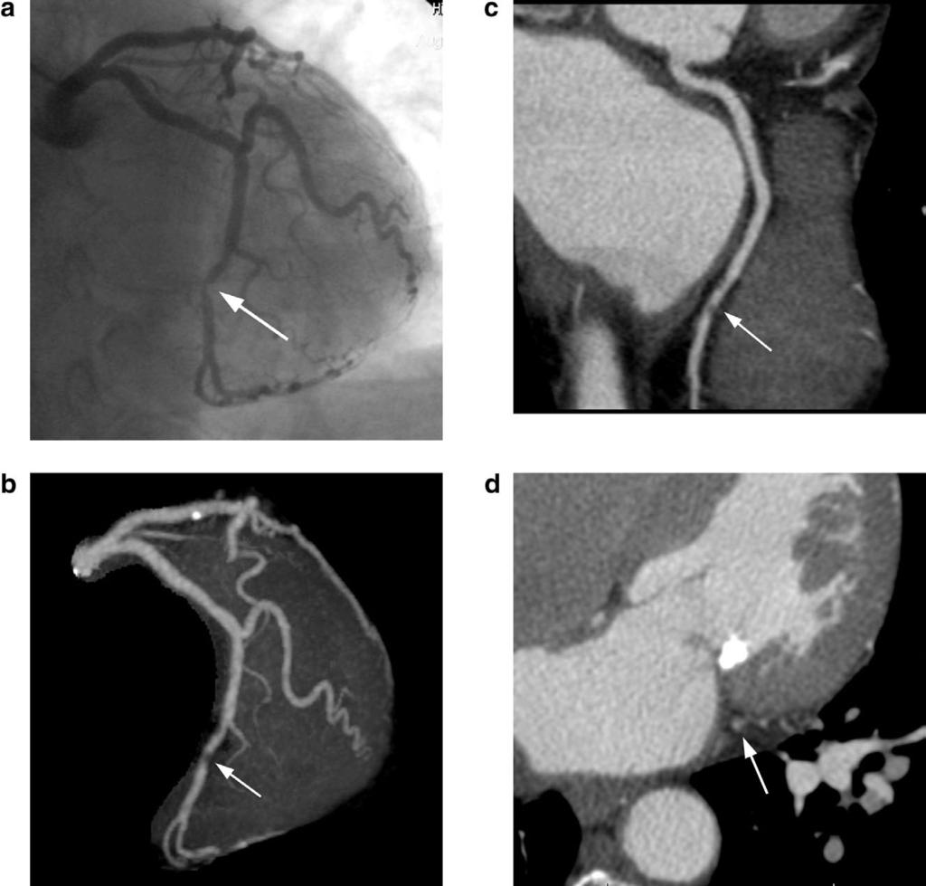 Diagnostic Accuracy of Angiographic View Image Advance Publication by J-STAGE Figure 2.