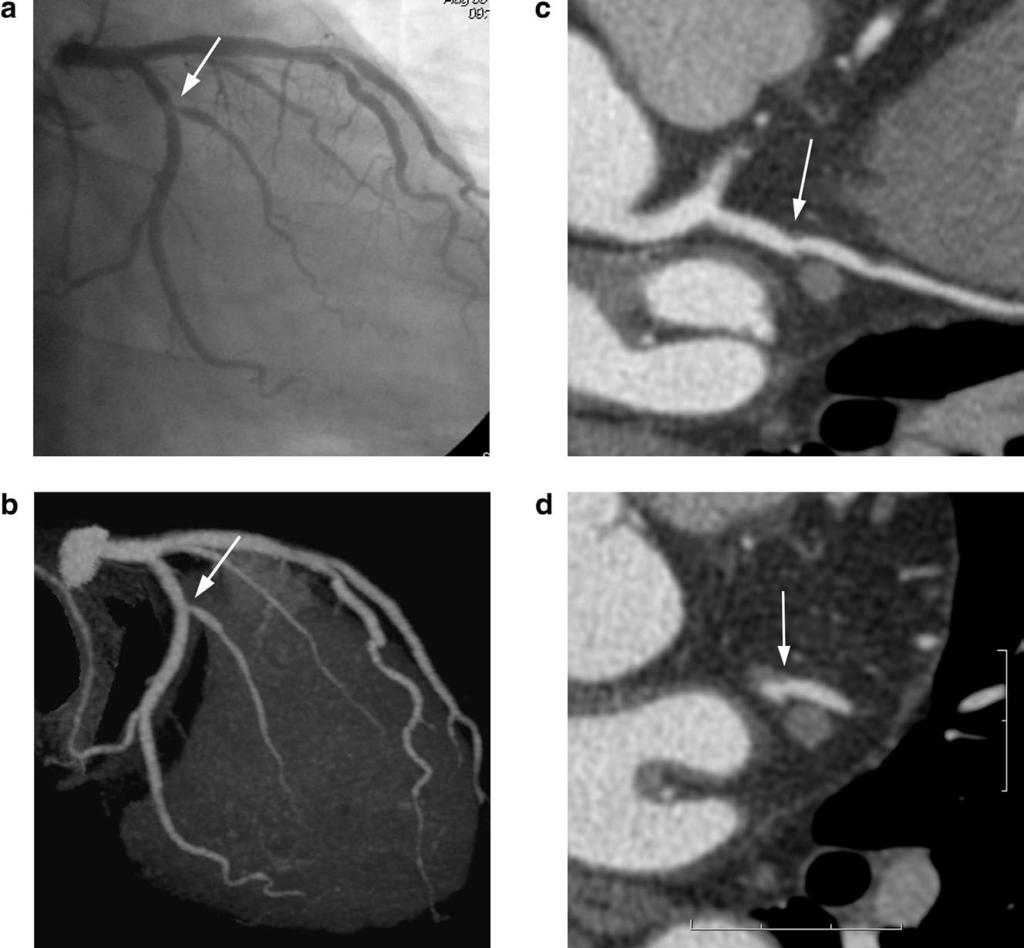 Diagnostic Accuracy of Angiographic View Image Advance Publication by J-STAGE Figure 4.