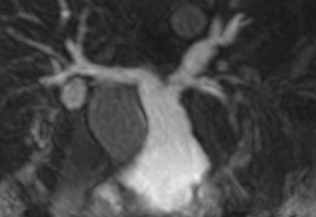 Additional information by CMR Contrast-enhanced MR angiography : Anatomy RVOT Pulmonary arteries side branches Velocity