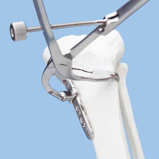 Using atraumatic technique, secure the plate to the tibial shaft with bone forceps. Confirm rotational alignment of the extremity by clinical examination.