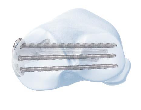 5 mm LCP Medial Proximal Tibia Plate is available in stainless steel or titanium and has a limited-contact shaft profile. The head and neck portions of the plate accept 3.5 mm locking screws and 3.