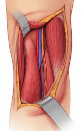 4 Retract semimembranosus muscle Identify the semimembranosus muscle and retract it medially. The insertion of the medial head of gastrocnemius becomes visible.