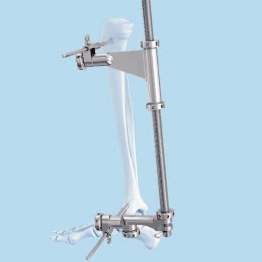 Fracture Reduction and Screw Insertion 1 Reduce fracture Instruments 394.