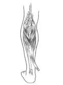 Operative Technique for a Medial Gastrocnemius Flap (cont d) The muscle is transposed anteriorly at the level of the knee joint to cover the tibial tubercle and is sutured to the fascia of the