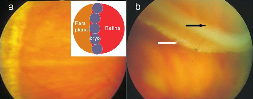 Data collected for each patient included relevant demographic information and ocular history, including previous RD, whether prophylaxis was given, duration of follow-up (from prophylaxis to latest