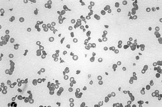 104/12 Fig. 1 Peripheral blood smear of the patient with acquired TTP: numerous fragmented erythrocytes (schistocytes) and severe thrombocytopenia count was 208 10 9 /l and haemoglobin 93 g/l.