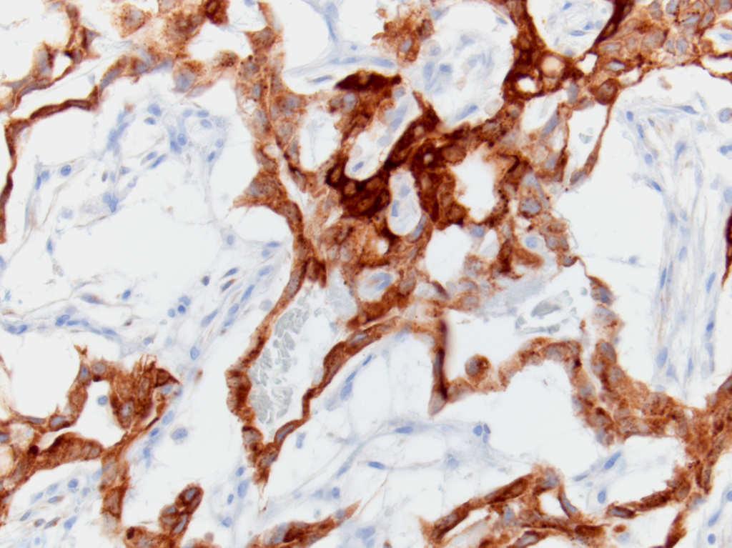 Glypican- 3 Yolk Sac Tumor Immunohistochemistry Stain Result Cytokeratin AE1/AE3 + Cytoplasm EMA, CK7 - OCT4, NANOG - SALL4 + Glypican 3 + Alpha-fetoprotein + CD30 - CD117 (c-kit) - D2-40, PLAP - or