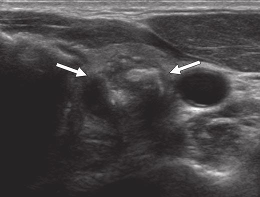 Hwang et al. Fig. 3 47-year-old man with papillary thyroid carcinoma that was negative for BRAF V600E mutation from fine-needle aspiration samples. On transverse sonogram, 1.