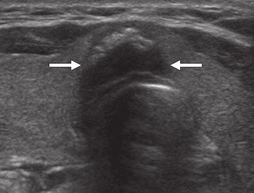 Sonography-guided fine-needle aspiration and total thyroidectomy confirmed papillary thyroid carcinoma with extracapsular invasion.