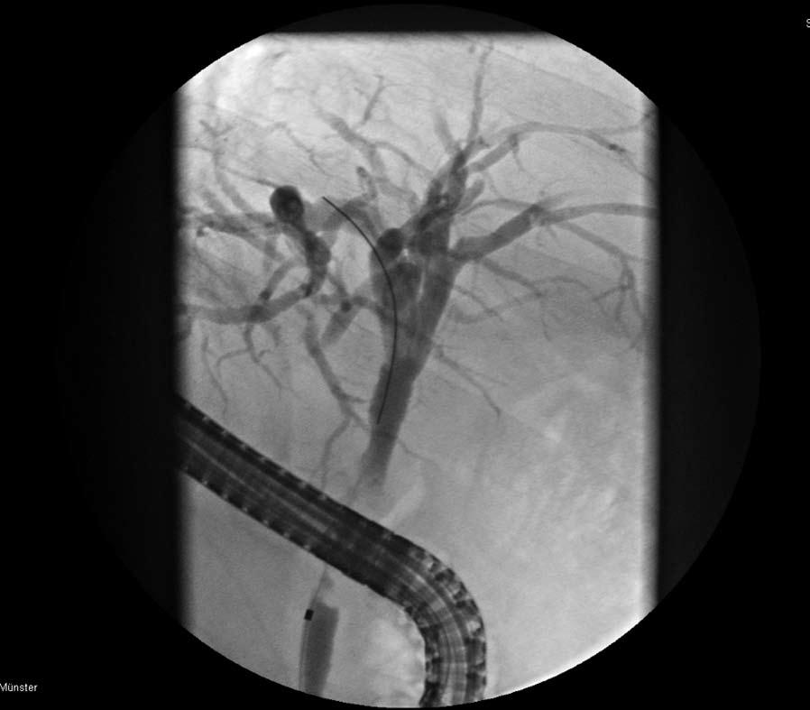 A B C Figure 1 Imaging of pancreatic cancer with a malignant bile duct stricture.