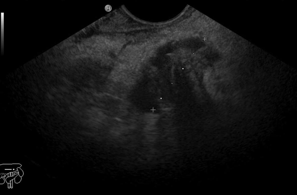 (indicated by an arrow); C: Computed tomography showing the tumor of the pancreatic head (indicated by an arrow) with an enlarged pancreatic duct. benign characteristics on IDUS or EUS.