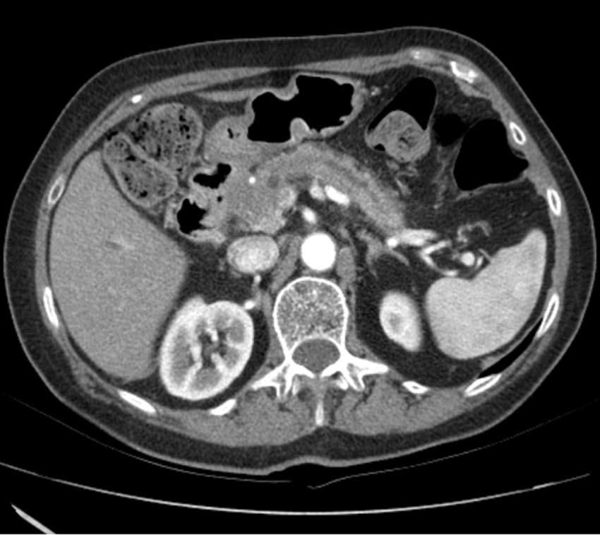 The characterization of a malignant biliary obstruction by ERCP followed the known criteria: irregularly shaped intraluminal filling defect of the bile duct, promptly and irregularly altered shape of