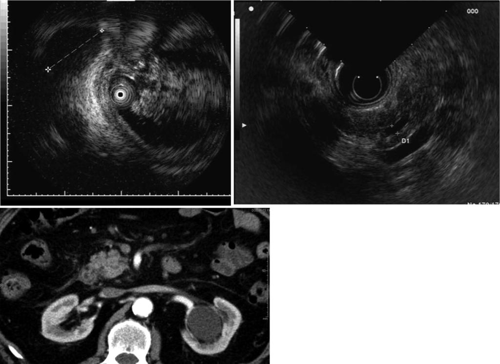 A B C Figure 2 Imaging of pancreatic cancer with a malignant bile duct stricture.