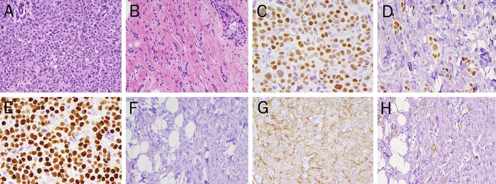 Figure 1. ER, PR, and HER2 IHC Pre- and Post- Neoadjuvant Chemotherapy. A. Pre-treatment core biopsy, infiltrating ductal carcinoma, Grade II, with lobular features (40x, H&E) B.