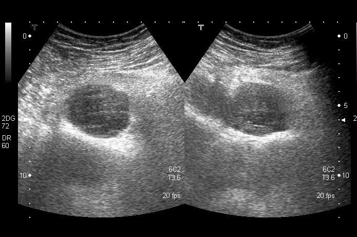 Coronal T1-weighted (A) and coronal STIR MR images (B) demonstrate an area of signal abnormality within the left ilium.