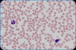 RETICULOCYTE PARAMETERS RETICULOCYTE HEMOGLOBIN Reticulocytes # and % Immature Reticulocyte Fraction (IRF) Measure of erythropoiesis Reticulocyte Hemoglobin (RET-He) Measure of hemoglobin content