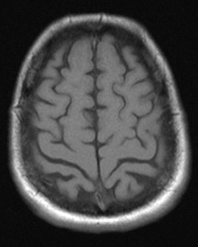 116 Romanian Neurosurgery (2010) XVII 1: 114-121 The MRI typical aspects in our case includes probably the two meningiomas in meningothelial and respective benign group.