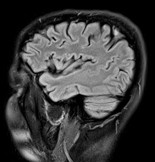 Figure 2 B Figure 2 MRI exam FLAIR