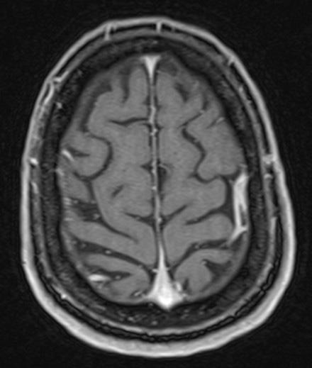 120 Romanian Neurosurgery (2010) XVII 1: 114-121 Figure 4 MRI exam T1
