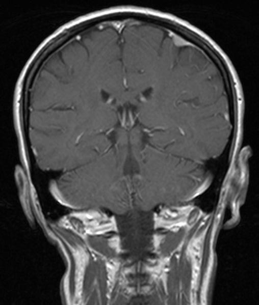 meningiomas with hipersignal and important and omogenous enhancement