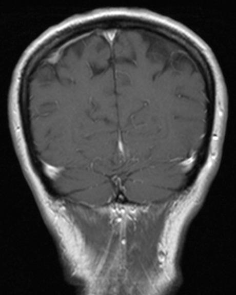 consecutives sections post contrast: Left and right parietal little