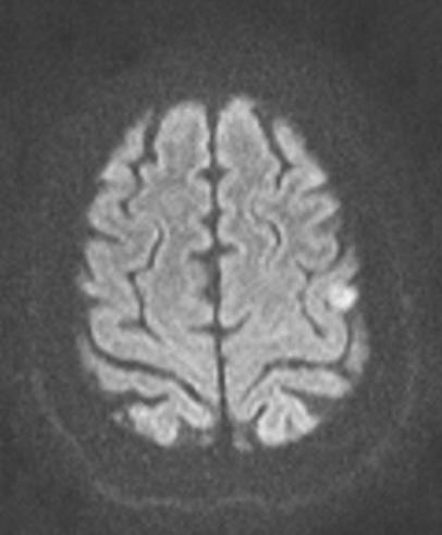 E. Moldovanu et al Multiple Meningiomas 121 Figure 6 MRI exam diffusion axial sections pre-contrast: Left parietal little meningioma with hipersignal References 1.