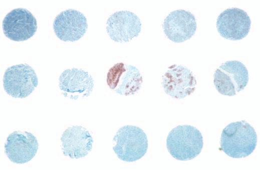 Anatomic Pathology / Original Article A B zimage 3z Low-power photomicrographs of basal-like breast carcinoma tissue microarray (TMA-2) demonstrating significantly less staining with cytokeratin