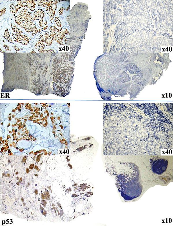 The p53 shifted in 11 cases/13.1% (Fig.2). In 8 cases/9.5% metastases lost p53 and in 3 cases/3.6% the tumor begins to express this marker in the metastatic site.