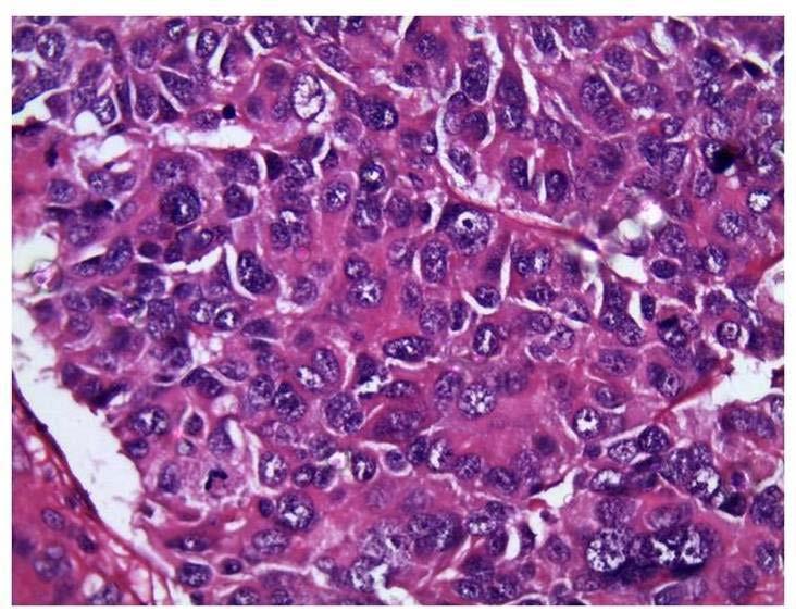 The various parameters analyzed were age, histological type, size of the tumour, grade, skin, lymphovascular and perineural invasions, number of axillary lymph nodes showing metastasis and staining