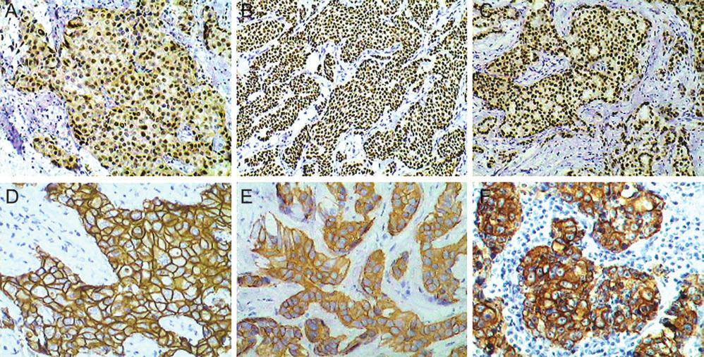 Annals of Oncology Figure 1. Immunohistochemical staining of each protein in breast cancer tissues.