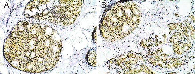 (B) Immunohistochemical staining of AR in DCIS components adjacent to IDC, original magnification 100. Table 5.