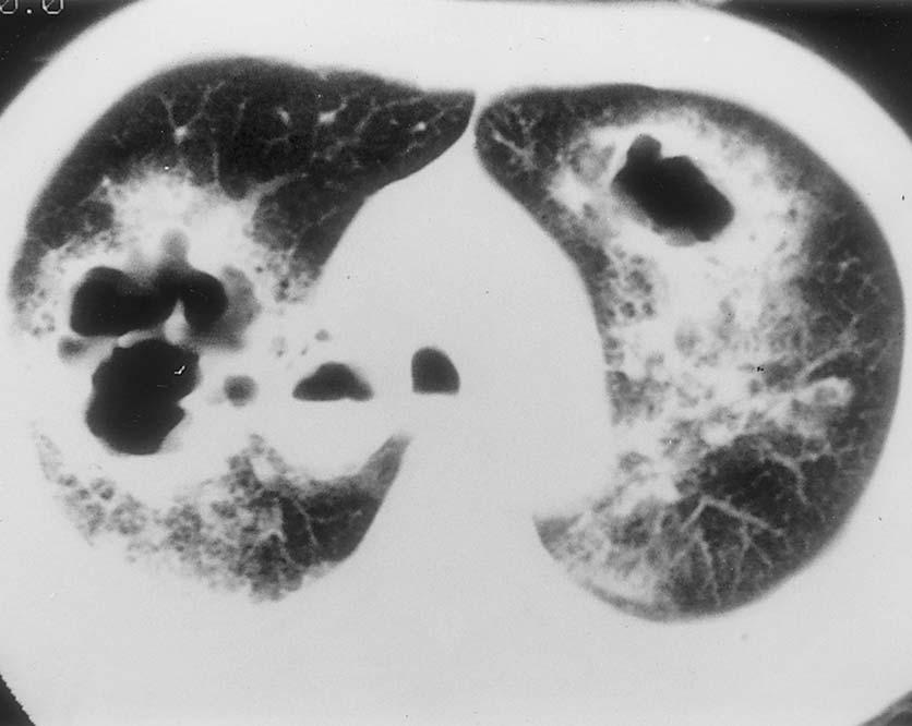 Radiographic findings of chronic necrotizing aspergillosis CT: cavitation with bronchial wall thickening and bronchial obstruction with obstructive pneumonitis