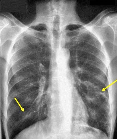 Radiographic findings in allergic bronchopulmonary aspergillosis CXR - homogeneous, tubular,