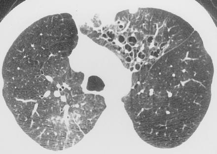 Radiographic findings in allergic bronchopulmonary aspergillosis On CT mucoid impaction and bronchiectasis involving the segmental and subsegmental bronchi of the upper lobes.
