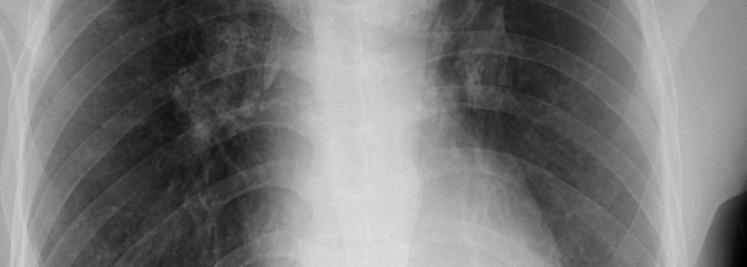 lung apices Superior retraction and fullness of the