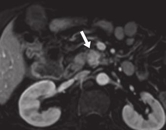 B, Curved coronal reformation of portal venous phase CT image clearly shows high-attenuation mass (arrow) at pancreatic head lying to right side of superior mesenteric vein (arrowhead) with