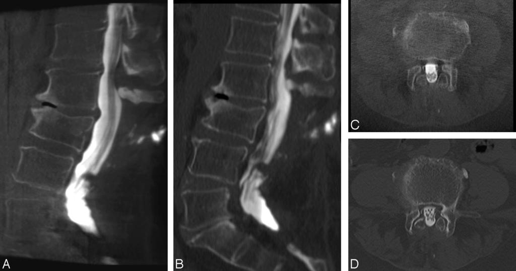 Fig 3. MPR images from a 75-year-old woman with persistent back pain after multisegmental laminectomy.