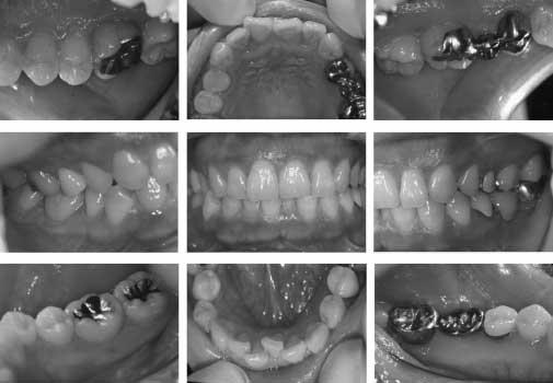160 Fig. 1 Clinical photographs at initial visit. Fig. 2 Radiographs at initial visit. Intra oral findings Clinical photographs at initial visit are shown in Fig. 1. Generalized redness and gingival swelling are seen.