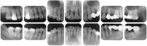 Open margin of crown prosthesis was seen in the upper and lower posterior regions, and plaque adhesion was seen on the pontic. However, there was no indication of bruxism or cuspal interference.