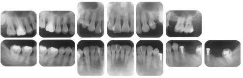 162 Fig. 3 Clinical photographs at re-evaluation. Fig. 4 Radiographs at re-evaluation. Discussion The main sex hormones exerting influence on the periodontium are estrogens and progestins.