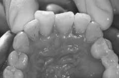 was high when compared with the menstrual phase. In addition, exacerbation of gingival inflammation corresponding to the menstrual cycle was observed.