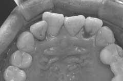 Generally, severity of gingival inflammation is correlated with plaque volume and better gingival conditions and oral hygiene instruction results in decreased plaque volume.