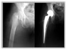 BZD Link with Accidental Falls In a recent Finnish study of patients with or without AD, BZDR use was associated with an increased risk of hip fracture in persons: With AD HR increase is 1.
