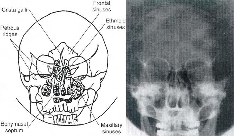 Section II. PROJECTIONS OF THE SINUSES 5-5. POSTEROANTERIOR PROJECTION (CALDWELL METHOD) a. Sinus Routine.