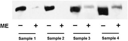 TABLE 2. Precision of ultracentrifugation/hplc analysis of serum LDL-C and HDL-C CV Serum pools Mean Within-run Total Fig. 3. Western blot of apolipoprotein B (apob) in centrifuged bottom fractions.