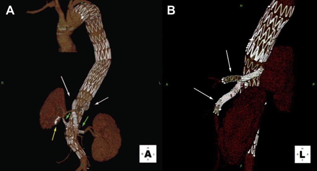 A larger balloon is then placed into the aortic portion of the stent and used to flare the stent against the aortic graft wall (lower panels). (From Greenberg R, Eagleton M, Mastracci T.
